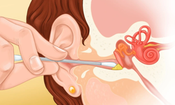 Neden kulaklarınızı pamuklu çubuklarla temizlememelisiniz?