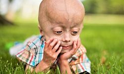 Progeria (erken yaşlanma) hastalığı nedir? Tedavisi var mıdır?