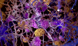 Yeni ilaç, beyin hasarına karşı kalkan gibi! Alzheimer'a yeni umut