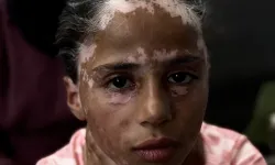 Gazzeli Lana, vitiligo hastalığına yakalandı