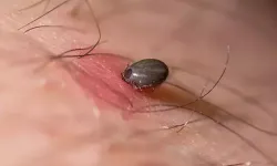 Gümüşhane'de kene ısırığı can aldı