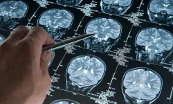 Alzheimer riskini artıran genetik varyant bulundu