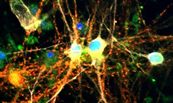 Alzheimer’ın görünmeyen yüzü! Beyindeki şeker depoları tehlike saçıyor