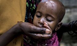 Sudan’da kolera salgını patlak verdi! Vakalar 18 eyalette görüldü