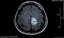 Glioblastoma tümörünün büyümesi ultrasonla canlı izlendi