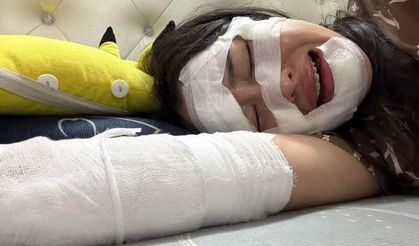 Dğum gününde elinde patlayan balon kadının yüzünü yaktı