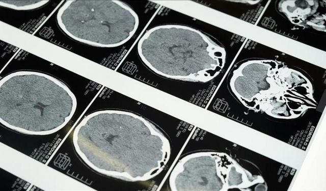 Uzmanlardan masajla gelen inme uyarısı