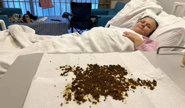 Doktorlar şaştı kaldı!  Safra kesesinden 20 binin üzerinde taş çıktı