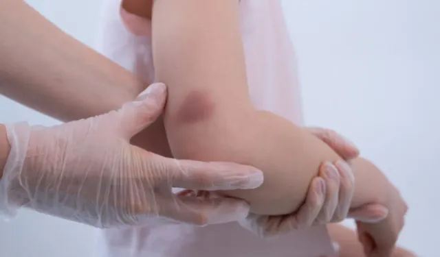 Çocuklarda kolay morluk oluşması ve uzun süren kanamalar hemofili belirtisi olabilir