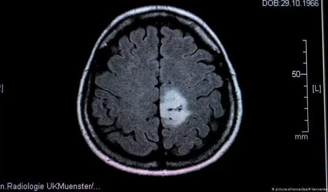Glioblastoma tümörünün büyümesi ultrasonla canlı izlendi