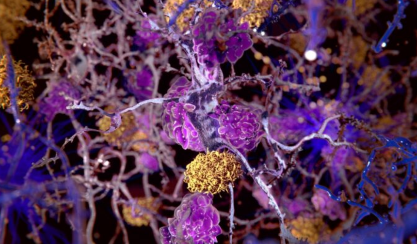 Yeni ilaç, beyin hasarına karşı kalkan gibi! Alzheimer'a yeni umut