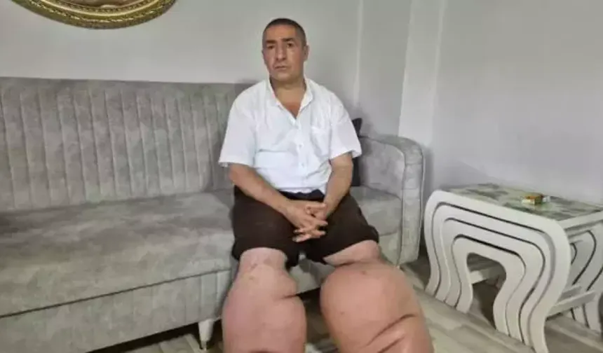 15 yıldır fil hastalığıyla mücadele ediyor