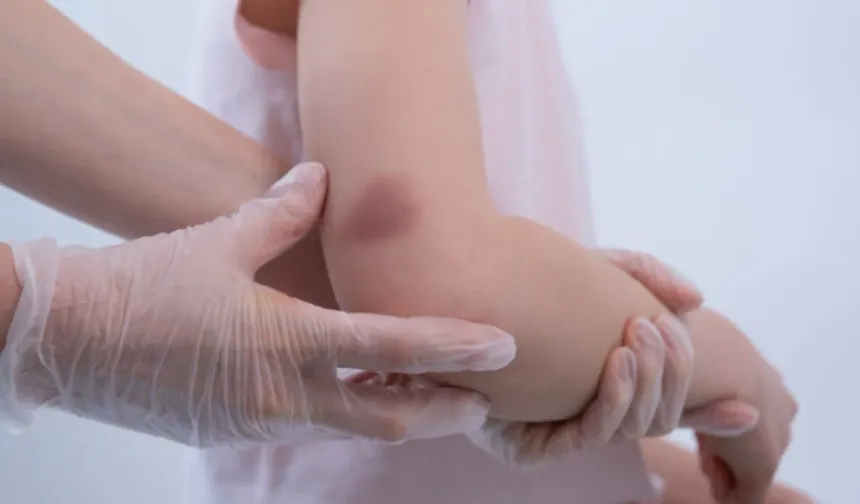 Çocuklarda kolay morluk oluşması ve uzun süren kanamalar hemofili belirtisi olabilir