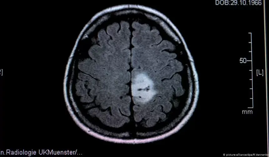 Glioblastoma tümörünün büyümesi ultrasonla canlı izlendi