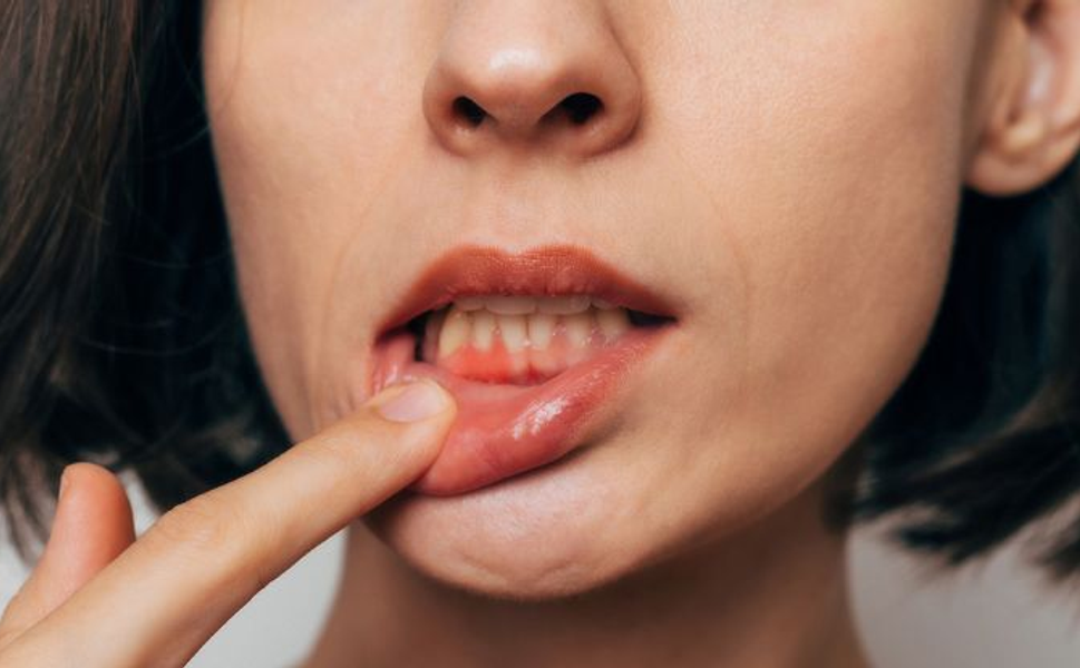 Diş eti çekilmesi olanlar dikkat! Kalp sağlığınız tehlike altında olabilir