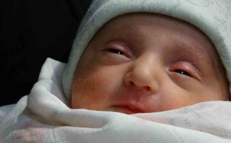 Nadir Tedaviyle Hayata Tutunan Bebek Dünyada 3. Vakaydı