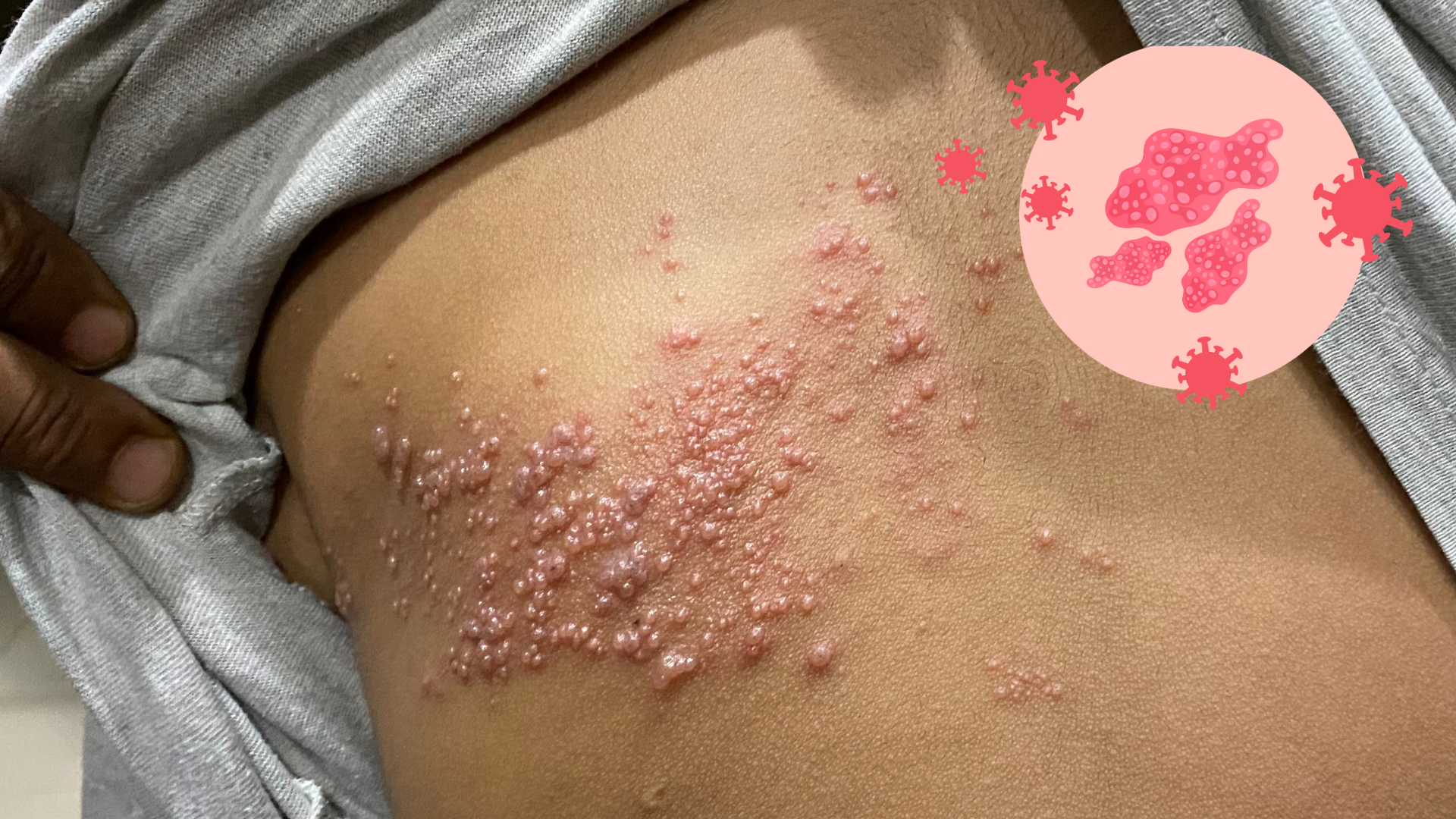 Zona Hastalığında Dikkat Edilmesi Gereken Besinler